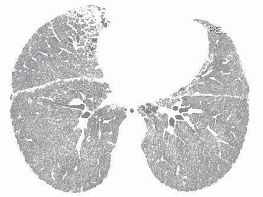 Brasileiro de Radiologia (5) e da Comissão de Imagem da Sociedade Brasileira de Pneumologia e Tisiologia (6,7).