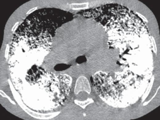 Figura 4. TCAR com janela para mediastino demonstrando extensas consolidações com densidade cálcica e broncogramas aéreos de permeio distribuídas bilateralmente pelos pulmões.