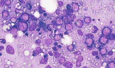 Em doenças autoimunes, auto-anticorpos atacam o tecido do próprio corpo, 1 resultando em doenças como a tireoidite de Hashimoto e doença de Graves.
