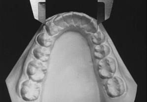 Porém, se a quantidade de movimento em ambos os locais utilizados como referência (ponta da cúspide e porção cervical da face vestibular) for igual, o movimento conseguido é de translação.