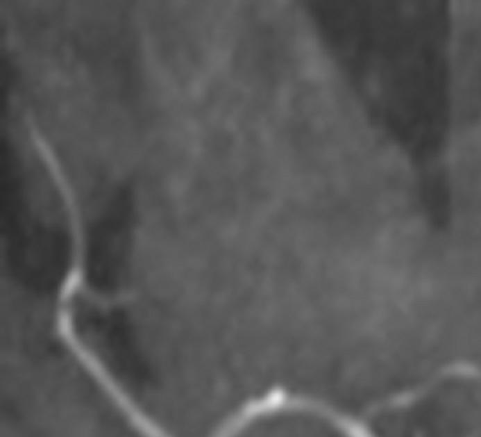 Figura 5. Angiorressonância arterial encefálica mostrando fluxo periférico no aneurisma e redução do fluxo sangüíneo à jusante. Figura 7.