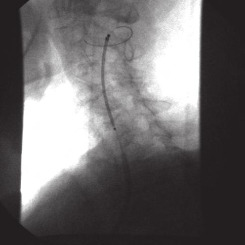 Figura 3B Pós-implante de stent.