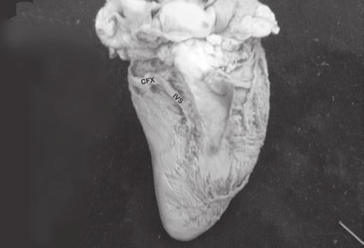 360 Paulo César Moura Junior et al. Fig.2. Ramo circunflexo (CFX) da artéria coronária esquerda emitindo o ramo interventricular subsinuoso longo (IVS). ramos.