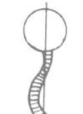 ESCOLIOSE DUPLA e TRIPLA Causada pela compensação da escoliose simples, geralmente localizada no desvio lateral inferior ou por encurtamento de algum membro