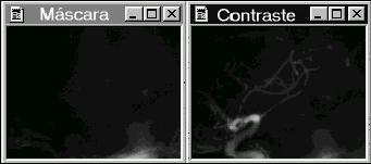 Figura 2 Imagens fontes (a) máscara (b) contraste A figura 3 mostra as imagens resultantes da subtração por complemento de um e por comparação 2. Figura 3 Imag. Resultantes (a) compl.