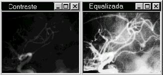 d apresentou uma qualidade de imagem bem inferior as demais. Podemos concluir que os métodos comparação 1 e "threshold" sobre imagem contraste (5.b) apresentaram resultados parecidos.