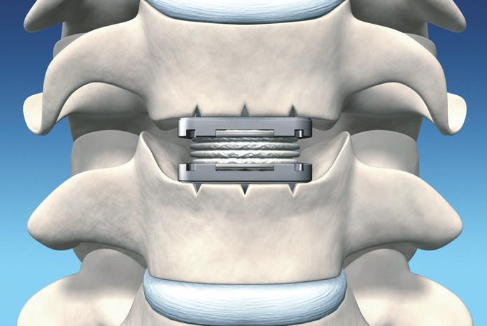 Oriente o cabo do insertor para que fique na trajetória do espaço discal conforme observado na visão lateral da fluoroscopia. (Fig.