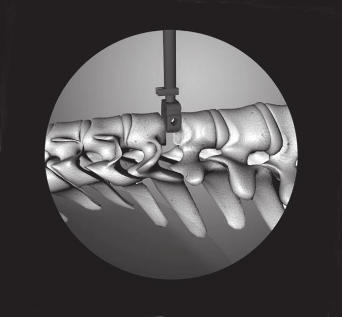 Insira cuidadosamente o teste de 6 mm adequado (médio, médio longo, grande, grande longo) no espaço discal sob orientação fluoroscópica.