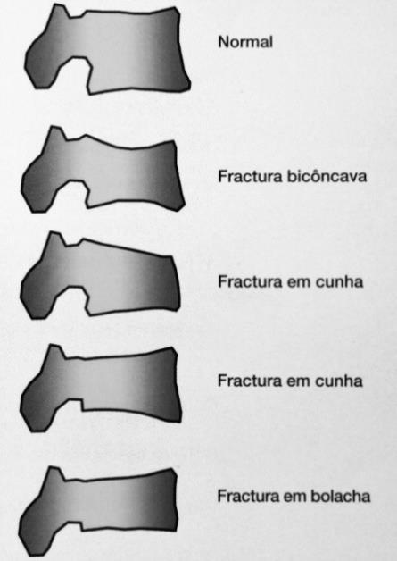 As fraturas vertebrais estão associadas não só a uma diminuição da resistência óssea, como também à Figura 5- Fraturas da coluna vertebral deterioração da microarquitectura do osso.