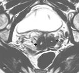 A RM é o método de escolha, uma vez que revela o eventual corno uterino rudimentar com ou sem tecido endometrial nas sequências ponderadas em T2 [7,8]. Fig. 4 Útero unicórnio. Imagens de R.