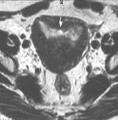 - Imaging Evaluation and Classification of Development Anomalies of the Female Reproductive System with an Emphasis on MR Imaging. AJR Am J Roentgenol, 1999, 173:407-16. 8.