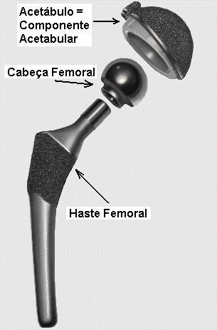 complicações ao longo prazo. Em média, uma prótese dura em torno de 15 a 20 anos. A superfície de revestimento/articulação é um ponto crucial no funcionamento da prótese de quadril.