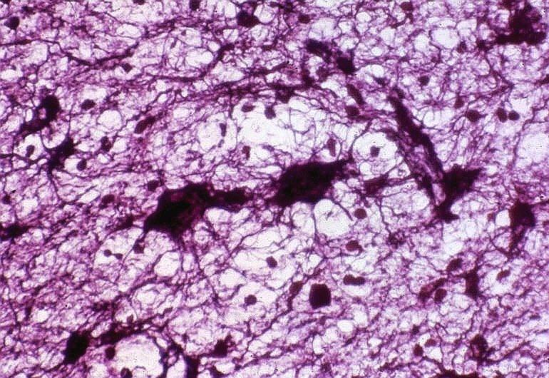 Astrócitos fibrosos resultam da evolução dos gemistocíticos, quando aqueles já produziram grande quantidade de