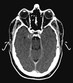 MATERIAIS E MÉTODOS 53 está ilustrado com um exemplo de imagens de crânio de um paciente em TC (FIG. 34a) e em RM do tipo T2 (FIG.