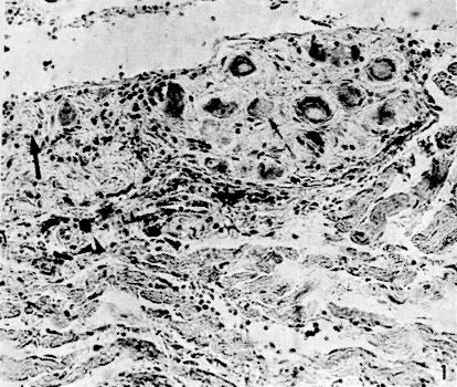 Revista da Sociedade Brasileira de Medicina Tropical 32:35-39, jan-fev, 1999. Figura 1 - Ganglionite e periganglionite: infiltrado inflamatório mononuclear e de mastócitos (cabeças de seta).