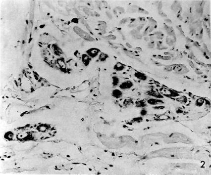 Figura 2 - Três gânglios constituídos por neurônios com morfologia e coloração de aspecto normal, sustentados por estroma frouxo escasso e delicado. Giemsa, 400x.