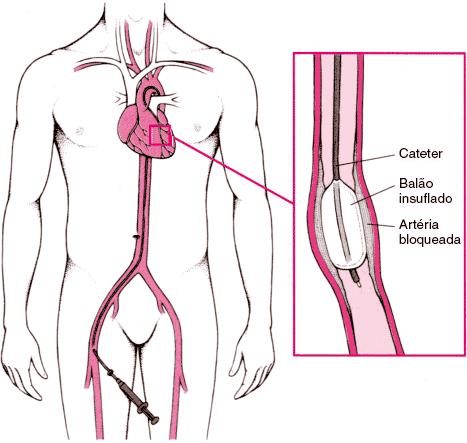 Angioplastia Técnica que utiliza um minúsculo