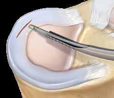 importante não empurrar a alça do Meniscal Cinch de maneira muito