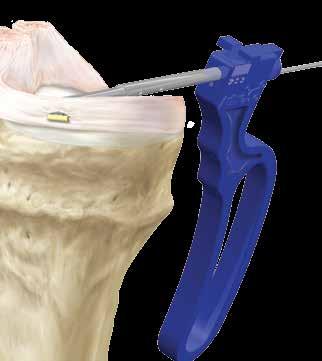 do Meniscal Cinch até que o trocarte do segundo implante tenha sido liberado da