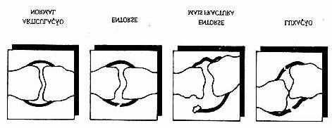 Luxação Verifica-se quando a cabeça de um segmento ósseo sai da sua articulação.