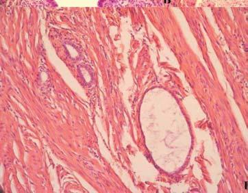 Kamergorodsky G, Ribeiro PAA, Galvão MAL, Lemos MANB, Donadio N, Aoki T (American Fertility Society-Revised, AFS-r) 12, que classifica a endometriose segundo a sua extensão e divide as pacientes em