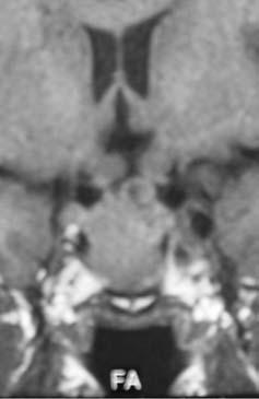 Ao exame: fácies com traços grosseiros, mas não característicos de acromegalia. Comparação com fotos antigas não mostrava mudanças significativas. Tireóide normal à palpação.