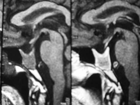 Figura 2. Ressonância magnética pós-tratamento com bromocriptina (imagens pré e pós-contraste).