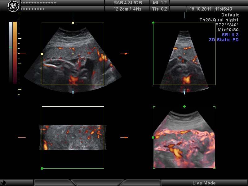 Revisão da Literatura 10 Figura 2 - Captação da imagem da placenta pela ultrassonografia tridimensional com power Doppler pelo método VOCAL Figura 3 -