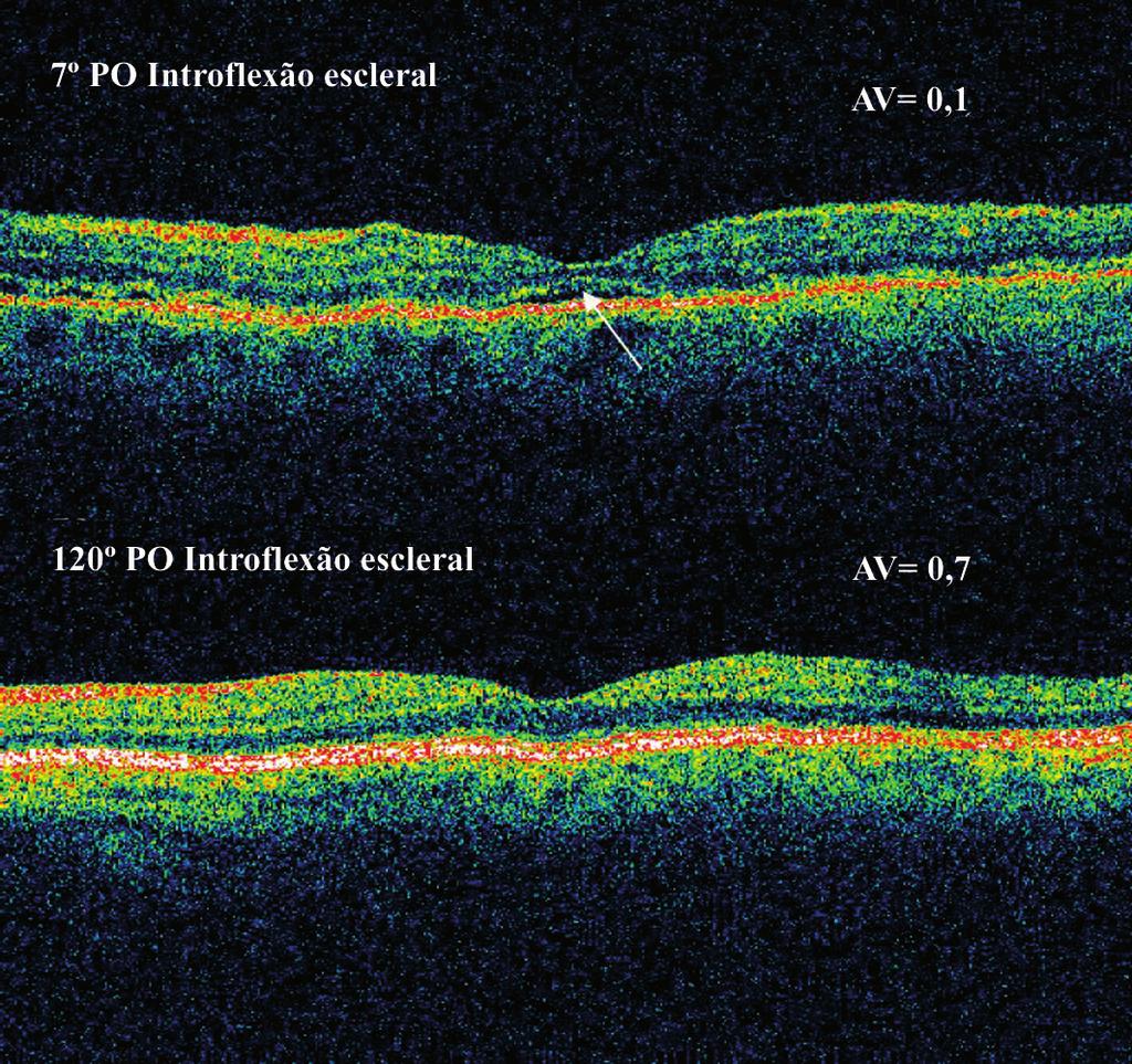 998 Descolamento regmatogênico de retina: avaliação pós-operatória da mácula a idade e final (r= -4 e p= 0,0127) e entre o tempo de descolamento e a final (r= -4 e p= 0,0447).