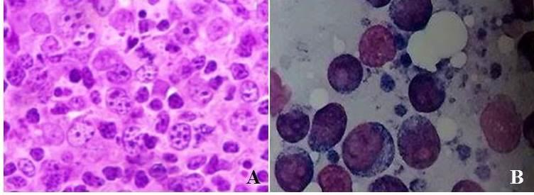 Os linfomas linfocíticos (Figura 1A) apresentam pequenas células de núcleos redondos e pequenos sem nucléolos evidentes e o citoplasma é sempre escasso.