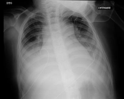 8 anos Agravamento da letargia Sem resposta a aumento de dose de metilfenidato Intolerância