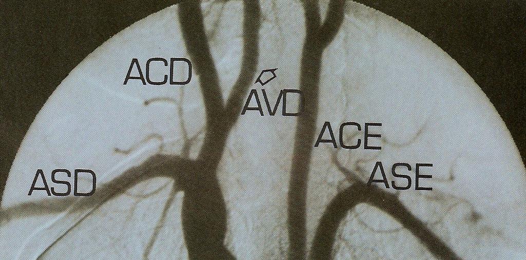 FIGURA 6 Arteriografia do arco aórtico mostrando o tronco braquiocefálico direito (TBD) e as artérias subclávia direita (ASD), carótida comum direira (ACD), vertebral direita (AVD), carótida comum