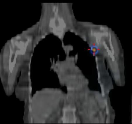 Figura 1 Pesquisa de gânglio sentinela em doente com carcinoma da mama esquerda, identificando um gânglio sentinela na axila