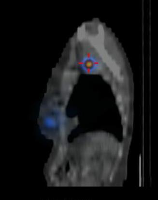 Quanto à terapêutica sistémica é importante salientar que depende francamente do tipo de receptores e padrão molecular que o