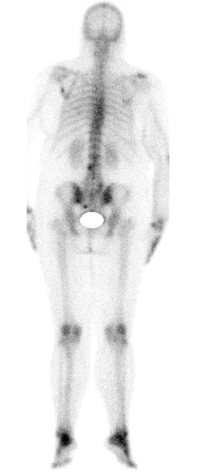 Figura 6 Cintigrafia Óssea de doente com carcinoma da mama demonstrando metástases ósseas de natureza blástica na