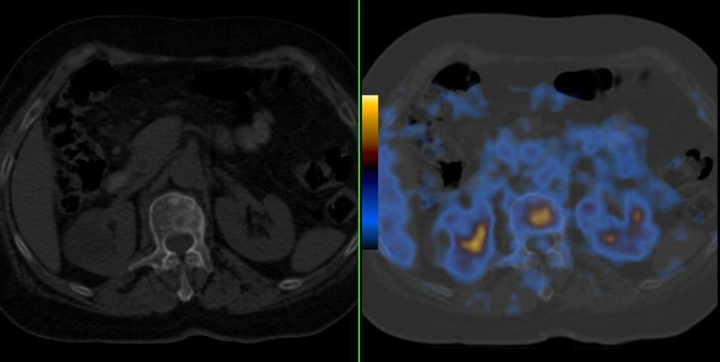 Figura 7 - Metástases vertebrais líticas e blásticas de carcinoma da mama. A captação de FDG verifica-se apenas na metástase lítica sendo as metástases blásticas apenas visíveis na CT.