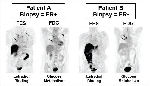 4.4.3 Estudo de doença metastática com FES-PET A FES-PET tem a capacidade de ver o estado funcional dos receptores de estrogénio em todo o corpo e portanto das metástases(40).