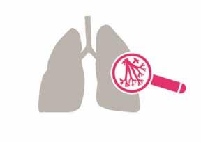 Os sintomas menos frequentes são tosse, tosse com sangue, tumores nos rins (angiomiolipomas), que ocorrem em cerca de metade dos casos, e derrames de quilo ou quilotórax (quando a linfa que se forma