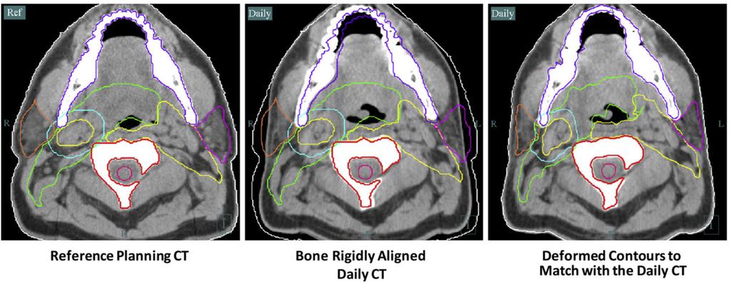 Neoplasia de Cabeça e Pescoço IGRT - Adaptativa 22 pacientes com cancer de orofaringe estadio IV CBCT e software de