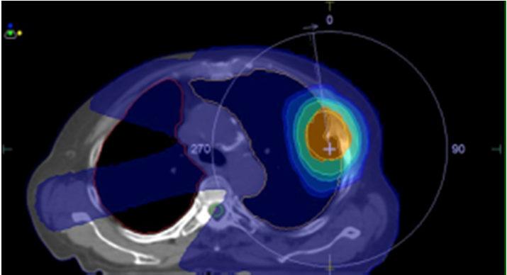 Alta Taxa de Dose Lung Previous Generation Versa HD PTV prescription 60 Gy 60 Gy High
