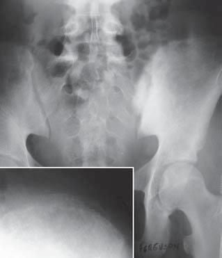 osteossarcoma, condrossarcoma); as com padrão II foram encontradas nos casos de osteossarcoma e em um tumor de Ewing (caso 6). A maioria das calcificações Figura 2. Caso 2.