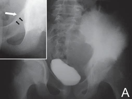 Oliveira GA et al. Figura 6. Caso 6. Tumor de Ewing. Menino de 12 anos de idade. A: RX evidenciando extensa esclerose no ilíaco esquerdo, associada a massa de partes moles que desloca a bexiga.