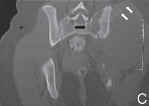 B,C: TC mostrando tênues calcificações amorfas, algumas afastadas do osso (setas brancas), e lesão lítica na asa esquerda do sacro caracterizando invasão (seta preta). A B Figura 9. Caso 9.