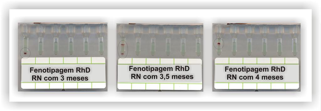 RN foi transfundido por mais 3 vezes, após o nascimento, devido a intensa anemia.