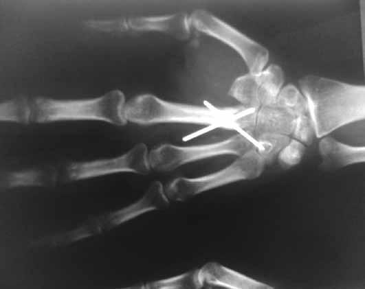 O radiograma realizado em maio de 2007 evidenciou hipertransparência com aumento de volume ósseo (Figura 1). Figura 2 Evolução da lesão em um mês.