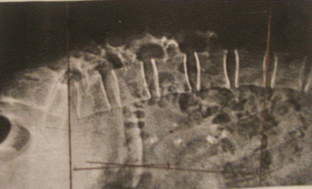 108 ANEXO VIII - Radiografia em flexão de tronco.