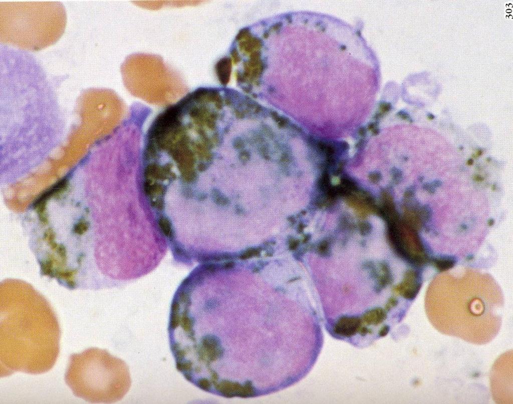 Leucemia mieloide