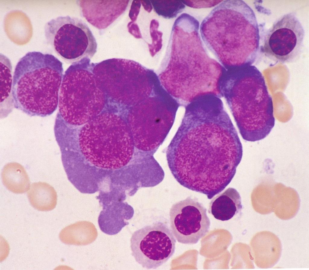 Eritroleucemia (LMA M6a) e