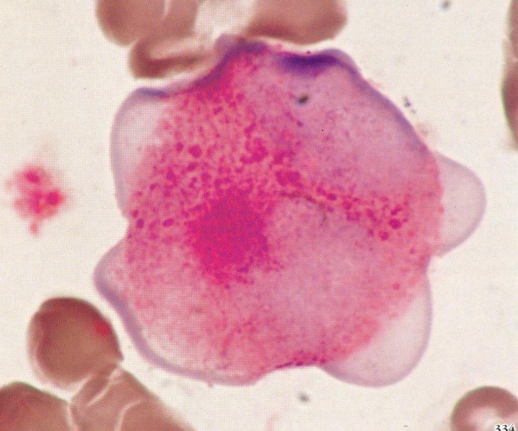 Leucemia