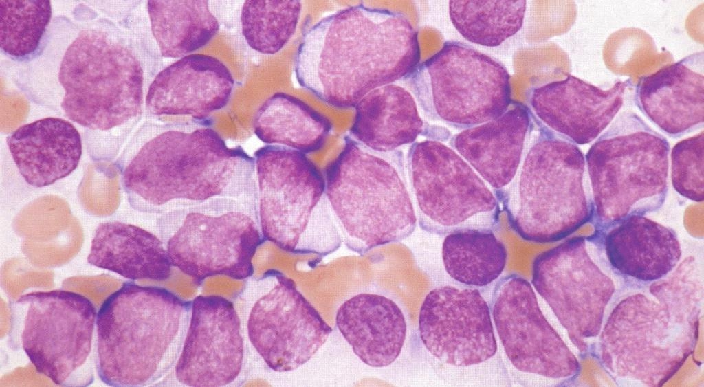 Leucemia com mínima